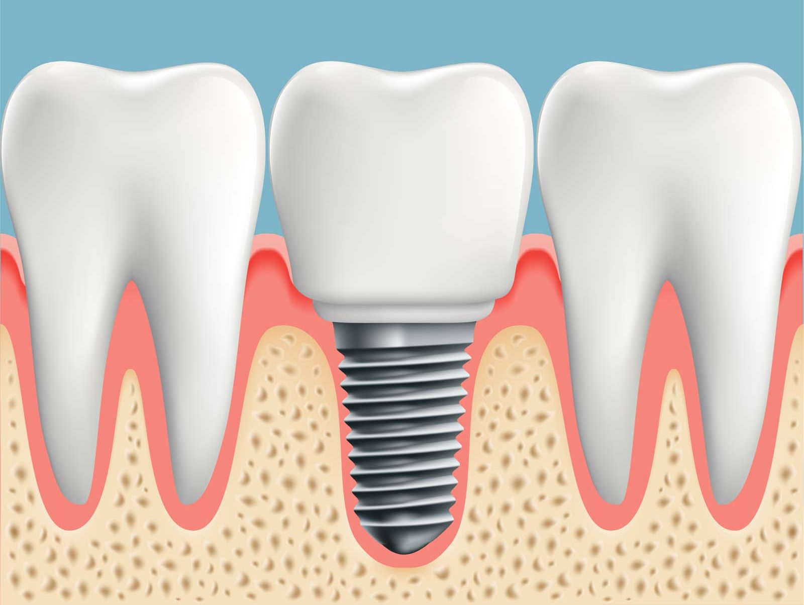 Восстановление костной ткани зубов. Дентальный имплантат. Имплантат коренного зуба. Имплантанты коренных зубов.
